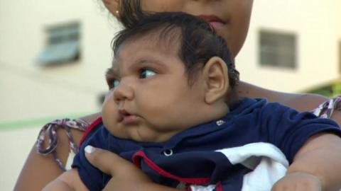 Baby in Brazil with microcephaly