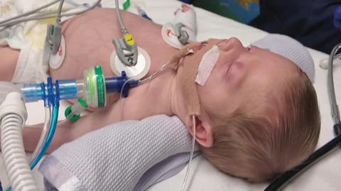 Carson in hospital in Winchester. He is 10 weeks old and lying in a hospital bed with various tubes coming out of his body and sensors on his skin. There is a white blanket rolled under his neck and he has a head of short blonde hair.