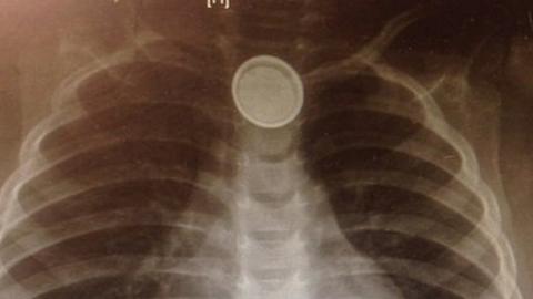 X-ray of button battery in oesophagus