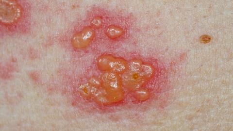 Image of Shingles which includes blotchy, blisters.