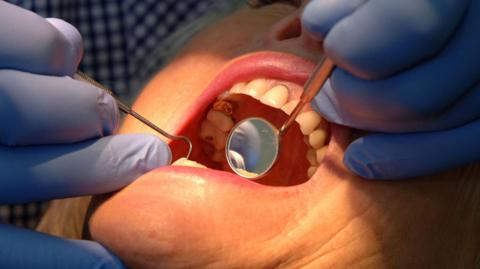 Close up of a person having their teeth examined by a dentist wearing blue gloves