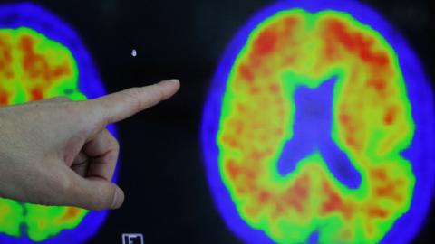 A brain scan is shown of the spread of Alzheimer's disease on the brain, with a hand pointing to the image. 