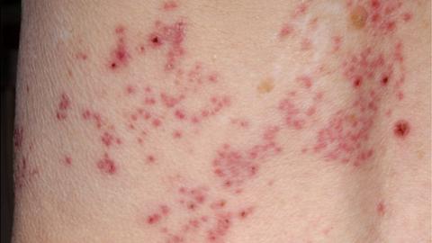 Shingles rash (herpes zoster)