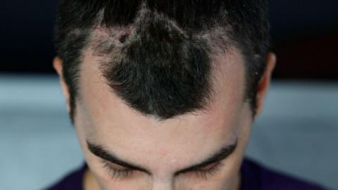 Tom Savage looking down. He has dark hair and a scar across the top of his head with a dark scab.