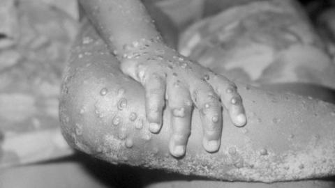 The arms and legs of a 4-year-old girl with monkeypox in Liberia