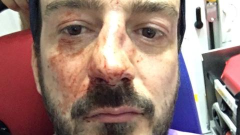 A photo shows a man with a clearly broken nose and blood on his face riding in an ambulance