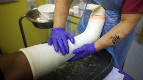 A leg, surrounded by a white cast is being held by a practitioner wearing purple plastic gloves.