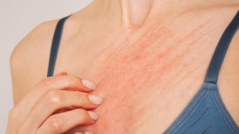 A woman in a blue top scratches at her chest, she has a red rash