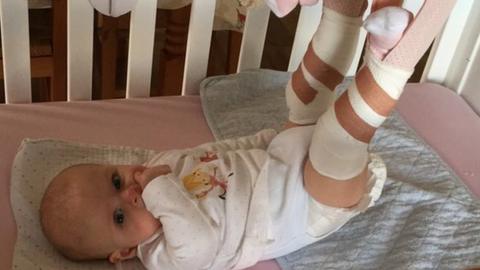 Rowan was in a cast and on a traction to treat her hip dysplasia