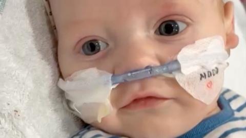 A baby with breathing apparatus in his nose is looking into the camera. He is wearing a white and blue striped top. On his face there is a sticky plaster with the words Macs and a red love heart written on the right hand plaster. 