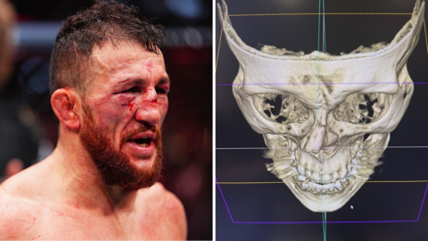 Split image of Merab Dvalishvili's nose bleeding and crooked in a fight and a scan that shows a nose broken in two places 