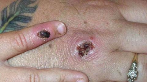 A monkeypox lesion