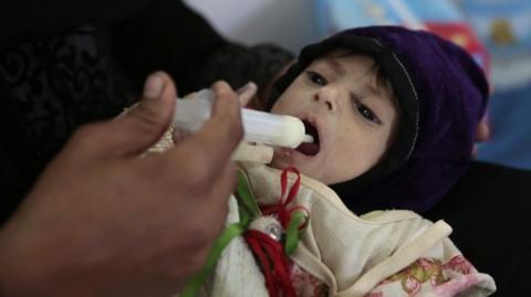 A Yemeni girl who suffers from chronic malnutrition.