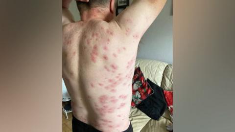 Wasp stings on man's back