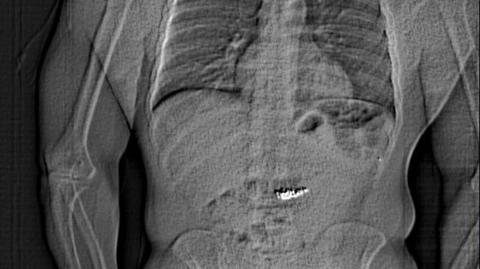 X-ray shows unknown item in person's stomach
