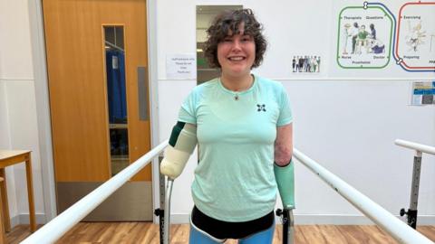 Lily is using parallel walking bars during rehabilitation in a clinical setting, wearing bilateral prosthetic legs and a partial arm prosthesis, with therapy equipment and instructional posters visible on the wall behind.