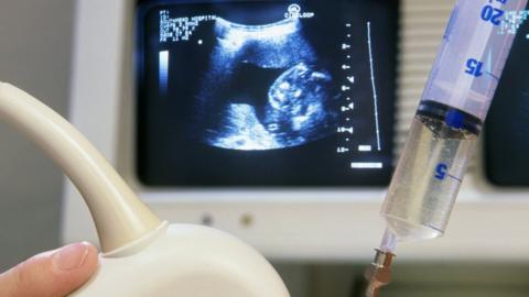 Ultrasound-guided amniocentesis