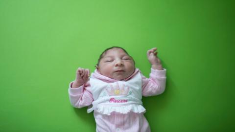 A two week old baby born with microcephaly in Paraiba state, Brazil