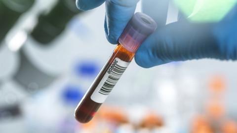 A hand holds a blood sample in a plastic container