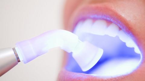 Teeth whitening