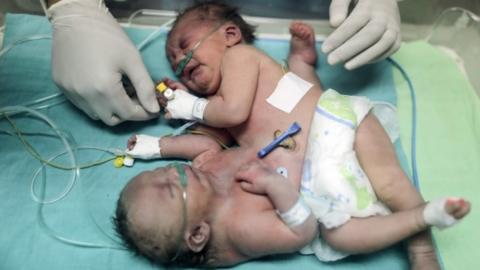 Palestinian conjoined twins lie in an incubator at the nursery of the Shifa Hospital in Gaza City (02 October 2017)