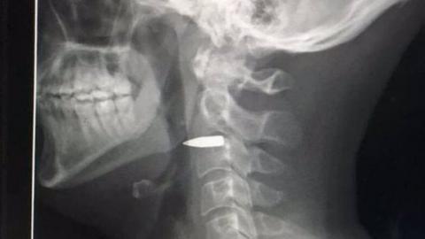 Tweet reads "Lucky" and picture shows an X ray image of a bullet lodged in a neck, between two vertebrae level with the jaw