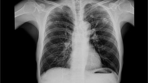 Chest xray to check for TB