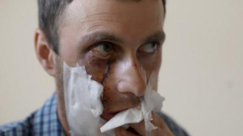 Injured face of Ukrainian man, Dmytro Bedrych, who was hurt when a mine exploded