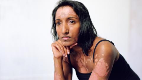 Ahila - who has psoriasis