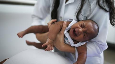 A 6-week old baby with microcephaly which results in an abnormally small head and decreased brain development