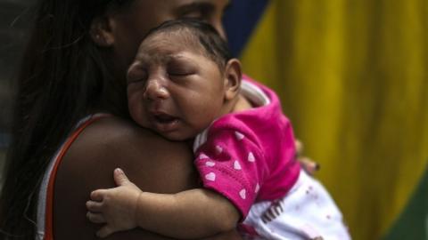 baby with microcephaly