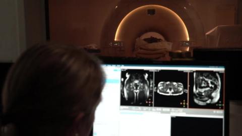 Looking for prostate cancer on an MRI scan