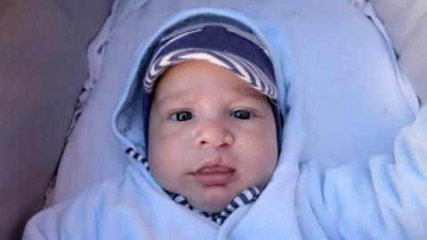 Baby with cleft lip