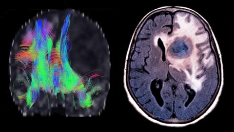 Glioblastoma on a brain scan