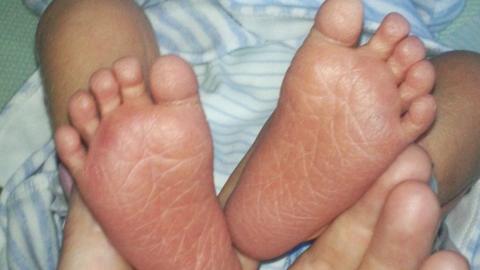 The baby's feet when born