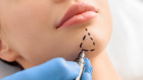 Surgeon's hands marking woman's jaw for surgery