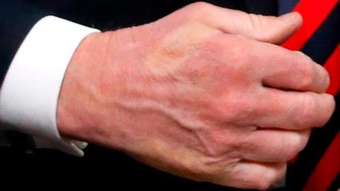 President Donald Trump's hand