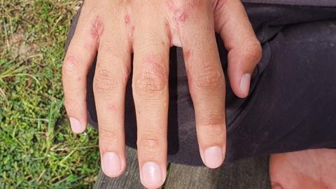 Hand held out showing the effects of scabies, including sores on fingers.