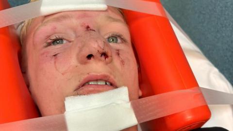 A 12-year-old boy, with blonde hair, lies on a hospital stretcher with his head held in place by an orange brace. There are bandages on his forehead and chin held in place by medical tape, he has dried blood and cuts on his face, and his nose is visibly swollen. 