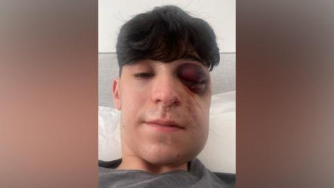 A man with black hair and a large swollen black eye and swollen cheek is lying on a bed with a white pillow and a grey headboard.