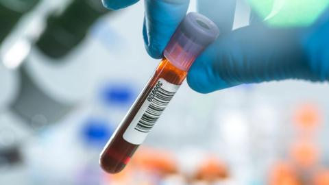 Test tube conatining blood for HIV test