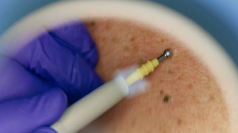 A person with a blue glove on looking at a person's skin through a magnifying glass