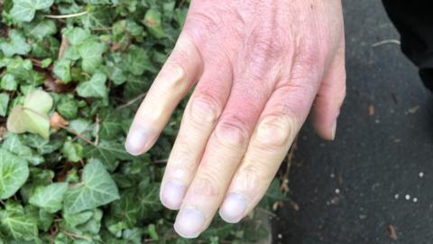 The hand of a man is pictured. Three quarters of his fingers lack colour and have turned white due to Raynaud's disease.