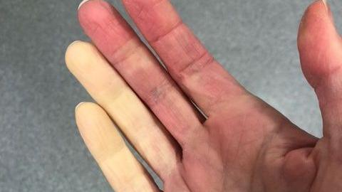 A generic view of a person's hands where two of their fingers have lost all colour and look yellow.