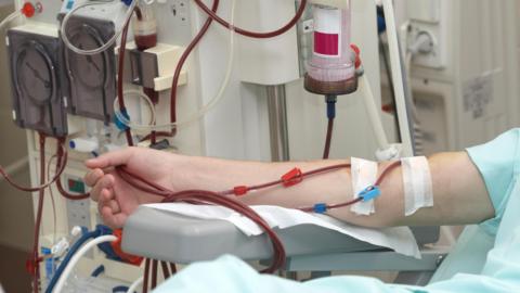 Dialysis patient having treatment. The image shows the patient's arm with tubes removing blood going to an external dialysis machine.