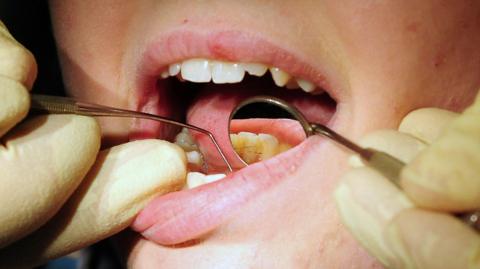 A person's mouth is examined by a dentist who is holding a small mirror and a dental scaler and wearing white gloves. The patient's mouth is open and a reflection of the back of their bottom teeth can be seen in the mirror.