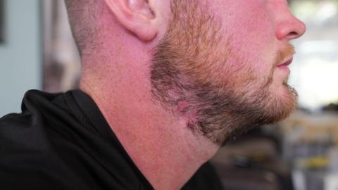Man with a beard facing sideways. There is a red mark where the sepsis spot used to be.