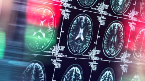 A human brain being scanned in a neurology clinic