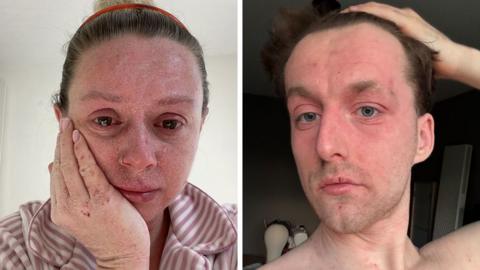 Two pictures of people with TSW. The left pic is of Rebecca and she has red, sore, peeling skin on her face. She is crying. The pic on the right is of Henry, he has a red face and he looks in pain