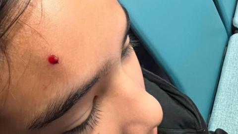 A cut forehead suffered by a young football fan